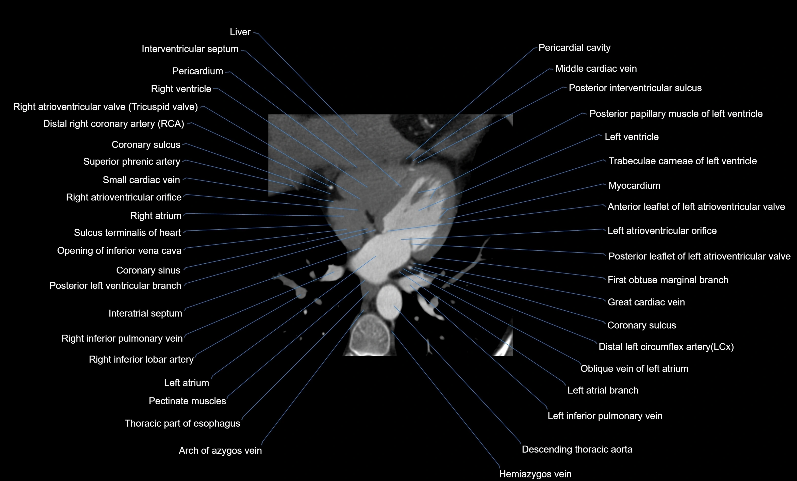 CT heart (coronary angiogram) four chamber view  cross sectional anatomy labelled radiology image -00035.webp